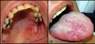 Image result for Pyoderma Gangrenosum