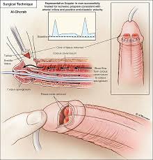 Image result for Priapism