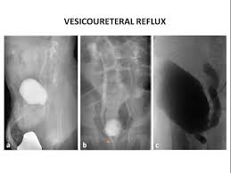 Image result for Voiding Cystourethrogram