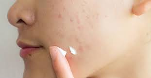 The best time to start using active treatments on dark marks is when the marks are no longer an open injury. How To Get Rid Of Acne Scars Treatments And Home Remedies