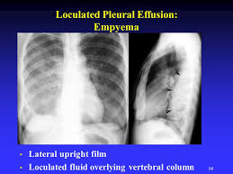 Learn about different types of pleural effusions, including symptoms, causes, and treatments. Pleural Disease Ppt Video Online Download