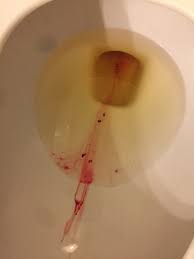 May 08, 2018 · ovulation spotting usually lasts a day or two. Is Ovulation Spotting Bright Red Please Help Glow Community