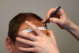 L'unica differenza è nel fatto che il capo del . Trapianto Di Capelli Senza Rasatura Health Beauty Turkey