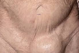 Image result for Inguinal hernia man