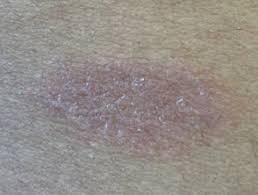Pityriasis lichenoides et varioliformis acuta. Pityriasis Rosea Dermnet Nz