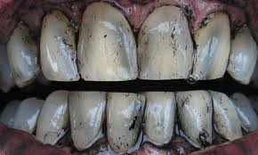 Pin On Teeth