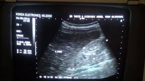 Renal Parenchymal Disease Imaging.Pptx
