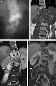 Image result for Spinal Infection