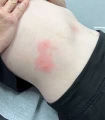 Image result for mite bites on humans