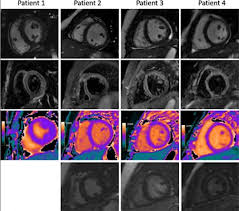 Myocardial edema can be also assessed by calculating the t2 signal intensity ratio between myocardium and skeletal muscle within the same image 1,2. Cardiac Mri Aids Evaluation Of Children With Multisystem Inflammatory Syndrome Mis C Associated With Covid 19 Daic