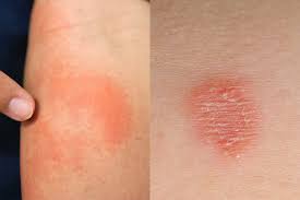 Image result for ringworm