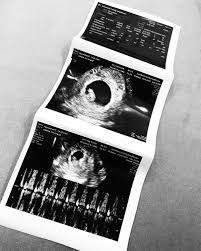 Cara mengetahui taksiran berat janin sesuai usia kehamilan. Unggah Foto Hasil Usg Lindswell Umumkan Hamil Anak Pertama Popmama Com