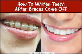 You can buy baking soda at a grocery store or. Can You Whiten Your Teeth After Braces At Home Orthodontic Braces Care