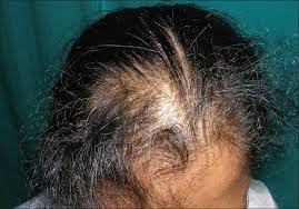 Cincotta, these are the key ingredients that can cause buildup on the hair and scalp and should be avoided when possible: Indian Journal Of Dermatology Venereology And Leprology Telogen Effluvium