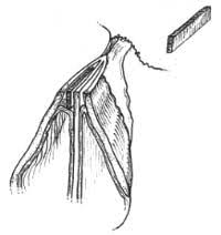 Middle third amputation of the nose for a bcc. Chapter 8 Spreader Grafts Becker Rhinoplasty Center