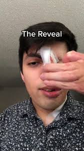 Reveal of Phase 1 of getting closer to my Zuko cosplay. #zuko #surgery  #burnsurvivor #failedfirebender #nosejob