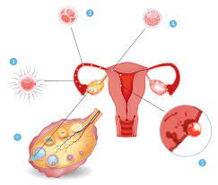 Nistet sich eine befruchtete eizelle in der gebärmutterschleimhaut ein, kann es zu einer einnistungsblutung kommen 2 wann tritt die einnistungsblutung auf? Ein Ei Wird Befruchtet