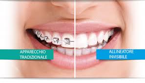 Apparecchi ortodontici (altri accessori per). Apparecchio Ortodontico Invisibile Denti Perfetti Senza Apparecchio Dentisti In Albania