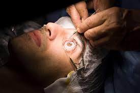 Who should not have lasik eye surgery? Is Lasik Eye Surgery Safe Lasik Eye Surgery Side Effects And Risks