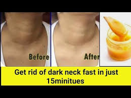 How To Get Rid Of Dark Neck Fast In Just 15minitues How To Remove Black Neck In Telugu Youtube In 2020 Dark Skin Around Neck Dark Spots On Neck Black Neck