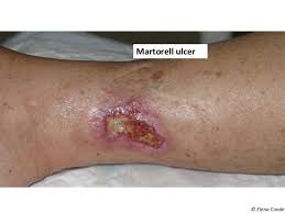 Pathophysiology and main differential diagnosis are discussed. Martorell Ulcer Elena Conde Montero