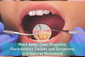 More Awful Than Gingivitis Periodontitis Causes And Symptoms 5 Natural Remedies
