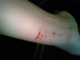 This only includes people who have public search listings available on facebook. Detail Gambar 35 Foto Tangan Berdarah Di Iris Silet Terbaru Riwayat Galler