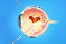 جراحة الشبكية والسائل الزجاجي Pars Plana Vitrectomy – بوابة التثقيف الصحي