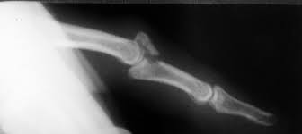 Image result for DIP Dislocation