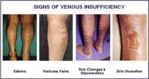 Vein Clinic Singapore Chronic Venous Insufficiency