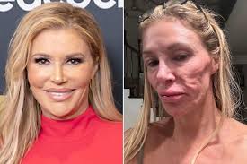 Brandi Glanville Spent $70K Treating a 'Parasite' That She Sees Moving in  Her Face: 'I Feel Like It's Having Babies'