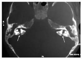 Cochlear Implantation In Isolated Large Vestibular Aqueduct Syndrome Report Of Three Cases And Literature Review