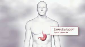 Gastrointestinal Risk Tylenol Professional