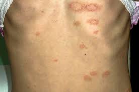 The disease is characterized by rashes and small lesions on the skin. Differential Diagnosis Pityriasis Gponline