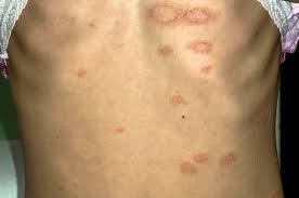 Sep 28, 2018 · pityriasis alba is a skin disorder that mostly affects children and young adults. Differential Diagnosis Pityriasis Gponline