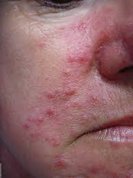 Rosazea Deximed