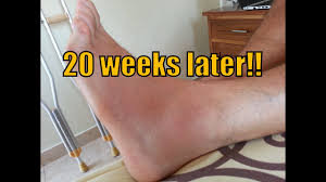 Grade 1 these are regarded as a mild sprain. Grade 2 Ankle Sprain Update Youtube