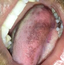 Image result for lichen planus on tongue)