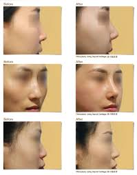 Aug 30, 2017 · by getting plastic surgery in malaysia you will be able to save thousands and thousands. Jk Jk Plastic Surgery Consultation Centre Penang Malaysia Facebook