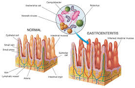 It is highly contagious and can be life threatening for some people. Gastroenteritis Healthdirect