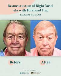 Before and After Reconstruction of Nasal Ala with Forehead Flap This  reconstruction is part of a process called MOHS surgery for removing skin  cancer. MOHS surgeries are typically performed in a series