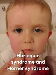 Trinity Tough 2 Rare Syndromes Shown In 1 Picture Facebook