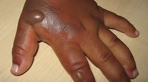 Burns Pictures Of Types And Symptoms