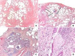 We did not find results for: The Role Of Histology In Idiopathic Pulmonary Fibrosis An Update Respiratory Medicine