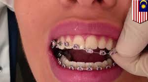Check spelling or type a new query. Bibir Wanita Terkena Infeksi Gara Gara Kawat Gigi Palsu Tomonews Youtube