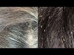Image result for lice vs dandruff