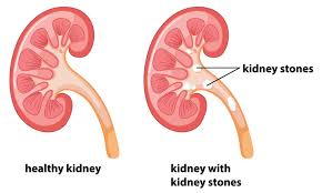 Do You Need Kidney Stone Surgery Health Plus