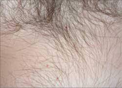 However, in the telengiectasias from rendu osler disease i am unsure if these lesions cannot be considered petechiae too because they are less than 3mm in. Skin Disorders In Older Adults Vascular Lymphatic And Purpuric Dermatitides Part 1