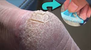 Here is a list of remedies with natural ingredients mostly available at home. Razor For Cracked Heels Live Callus Removal Youtube