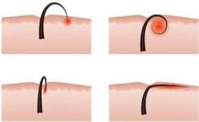 Ingrown hair is caused when the hair strand growing from the roots turns inwards or curls up within the skin. 6 Shaving Problems You Never Experience After Laser Hair Removal